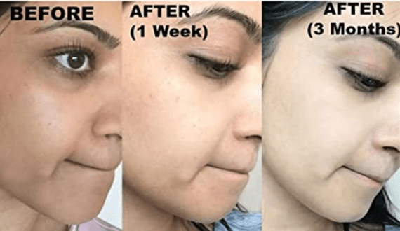 Kojie San Face Cream w/ HydroMoist 30g - True Beauty Skin Essentials